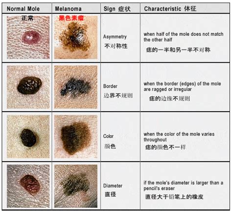 大拇指突然长痣|痣也可能会癌变！长在 3 个地方要注意